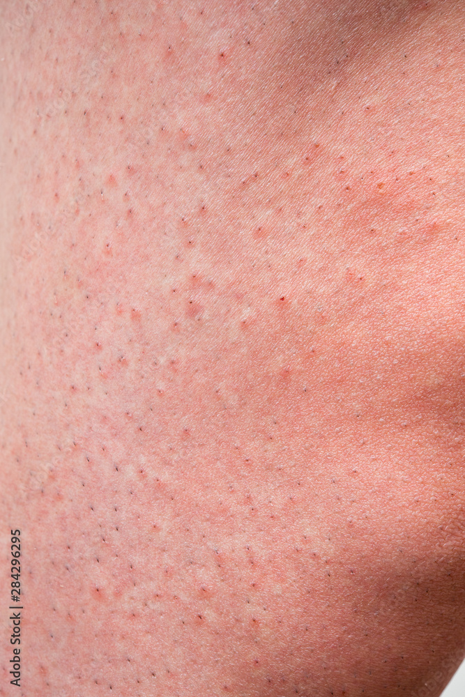 Fototapeta premium カミソリ負けして赤くなった男性の脚