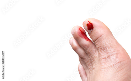 Fresh wounds on the floor man toe nails on isolated white background.