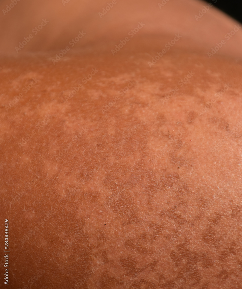 Fototapeta premium Sunburn on the skin of the shoulders. Exfoliation, skin peels off. Dangerous sun tan