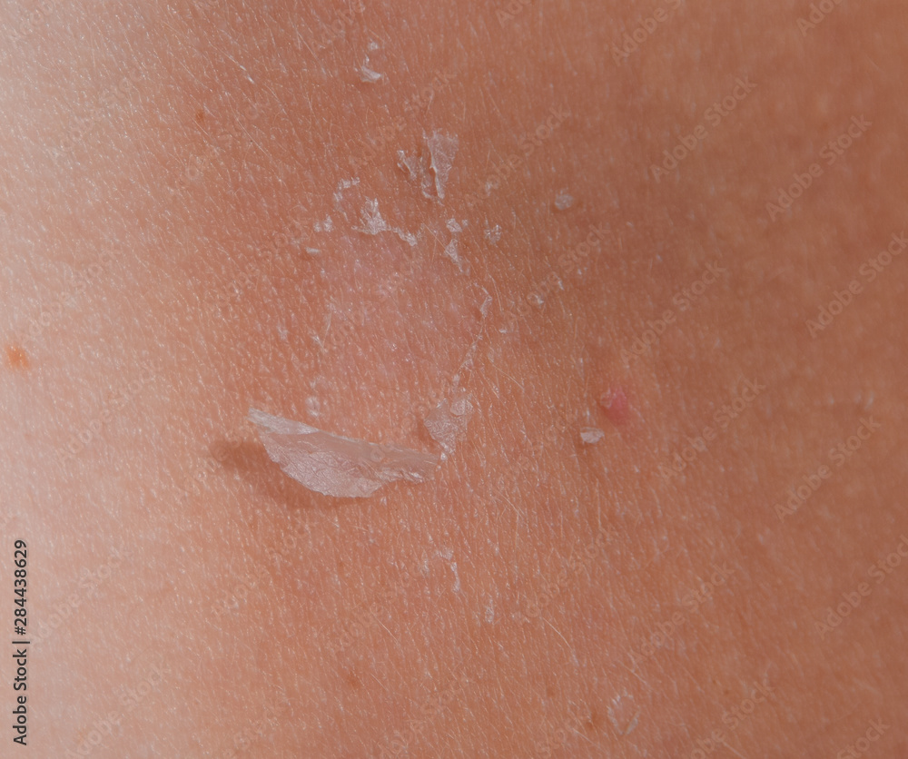 Fototapeta premium Sunburn on the skin of the back. Exfoliation, skin peels off. Dangerous sun tan