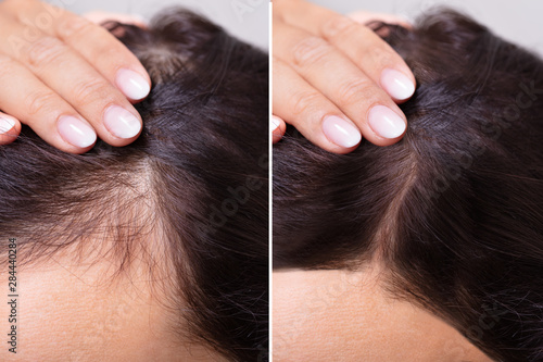Before And After Hair Loss Treatment