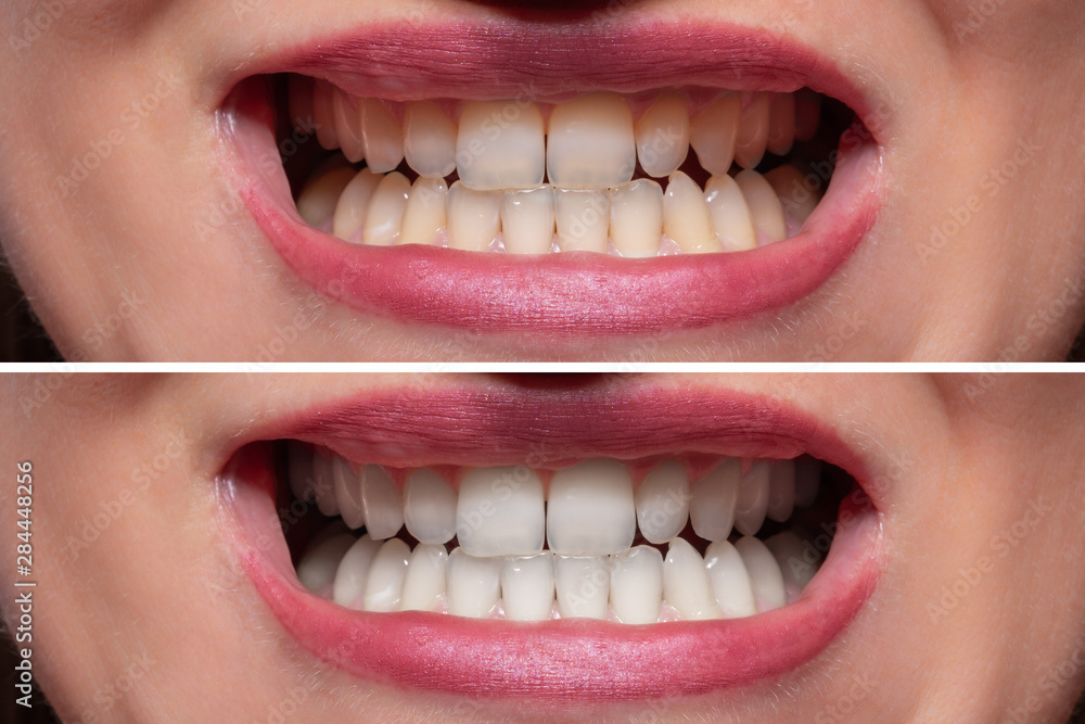 Fototapeta premium Person Teeth Before And After Whitening