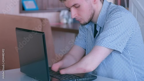 Portrait of disabled man with amputated two stump hands typing working on laptop in cafe, side view. Freelancer computer online job. Independent handicapped young guy invalid. Problem adaptation.