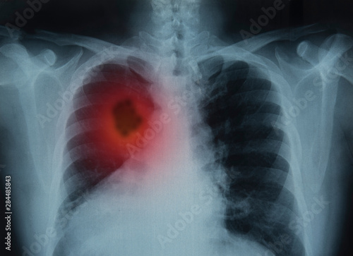 Bild auf Leinwand lung cancer