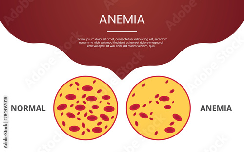 anemia blood cell concept theme for template banner or landing homepage infographics - vector