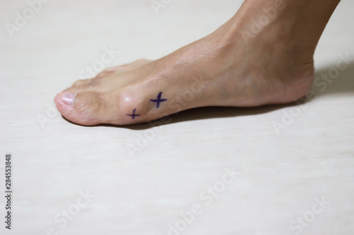 A doctor mark an Asian girl's feet Hallux Valgus before and after Proximal phalanx osteotomies.