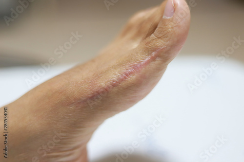 Scar of an Asian girl's feet Hallux Valgus  after surgery Proximal phalanx osteotomies.