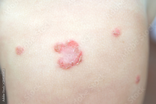Contagious bacterial dermatologic infection impetigo on a child skin without pharmacologic treatment. Macro shot with empty copy space for Editor's text.
