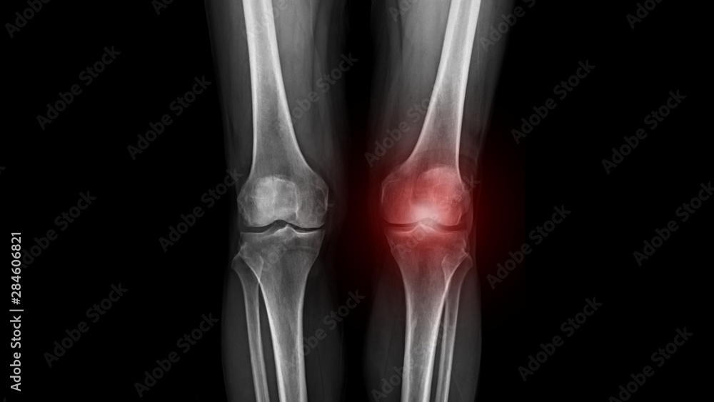 Xray Both Knee with left knee pain. Xray Both Knee with left knee pain.