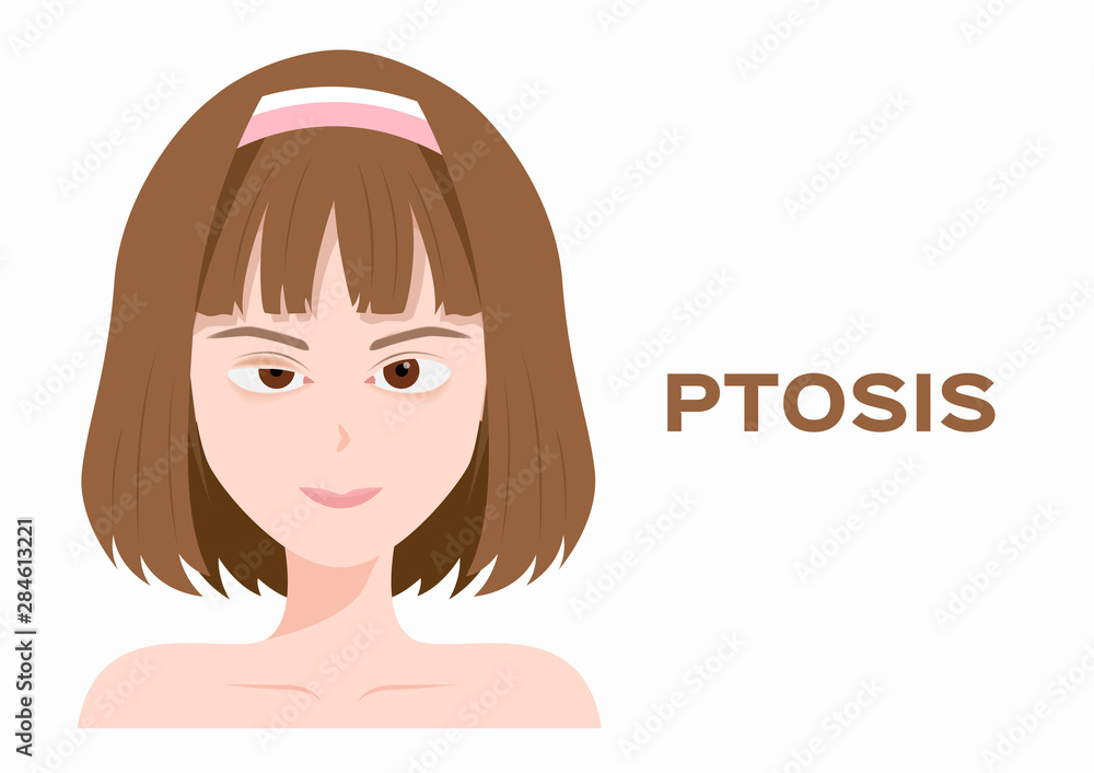 ptosis of eyelid . eye sickness anatomy vector ptosis of eyelid . eye sickness anatomy vector