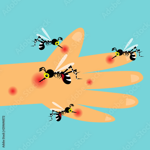 mosquito bite hand
