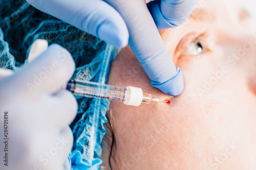 The procedure for the introduction of the active substance - under the skin  in pre-marked areas  injections of gualuronic acid are made - an ultrafine needle is used