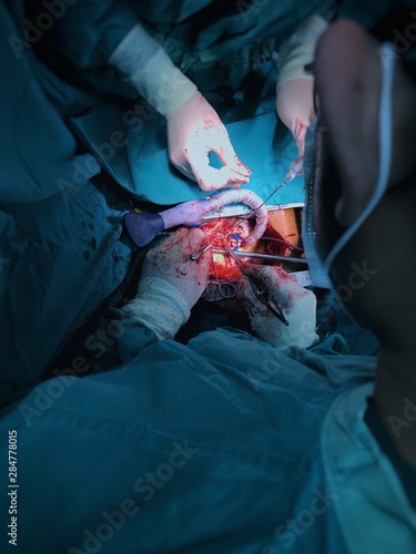 A doctor is operating coronary artery bypass graft by off pump method. Surgeon view, cool tone, central is focused and others part are blurred. green tone.