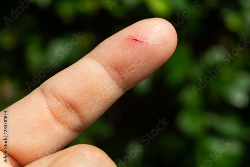 Obraz na plátne Woman has been cut index finger and scar skin on hand, Close up & Macro shot, As
