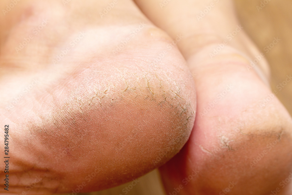 Naklejka premium Corn callus cracks on a sole heel foot close up. Dry skin dermatology problem.
