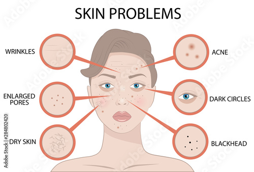 Girl Face with Skin problems, cosmetic care and beauty cosmetics medicine vector illustration isolated on white