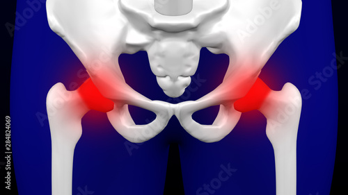 Disease of the joints. 3D rendering.