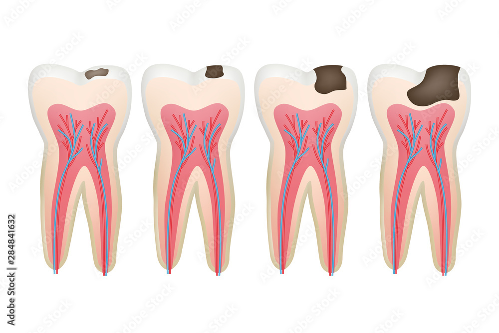 Caries tooth. Decay pulpit dental problem procedure root vector tooth