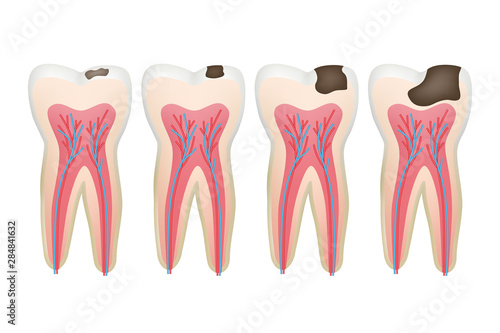 Caries tooth. Decay pulpit dental problem procedure root vector tooth medical pictures. Dental medicine, medical procedure, healthy cavity illustration