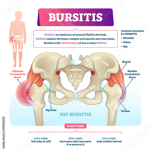 Bursitis vector illustration. Labeled bursae synovial inflammation scheme.