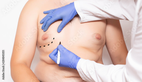 Doktor plastic surgeon preparation before surgery to reduce breasts in men  gynecomastia  lipolysis