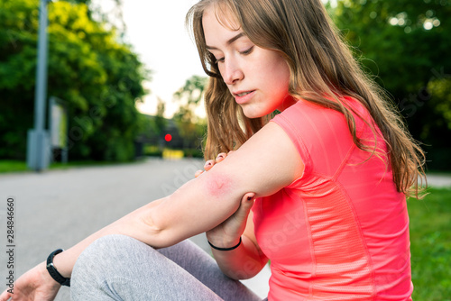 a young woman with insect sting on her arm