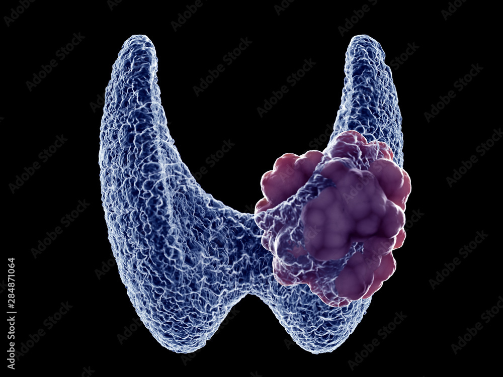 3d rendered medically accurate illustration of a thyroid tumor Stock ...