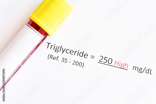 Blood sample with abnormal high triglyceride test result photo