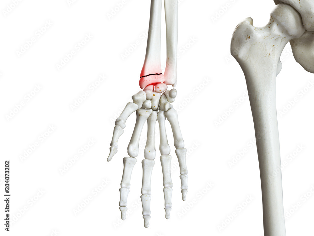 3d rendered medically accurate illustration of a broken wrist 3d rendered medically accurate illustration of a broken wrist