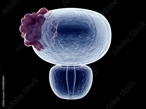 фотографія 3d rendered medically accurate illustration of a bladder tumor