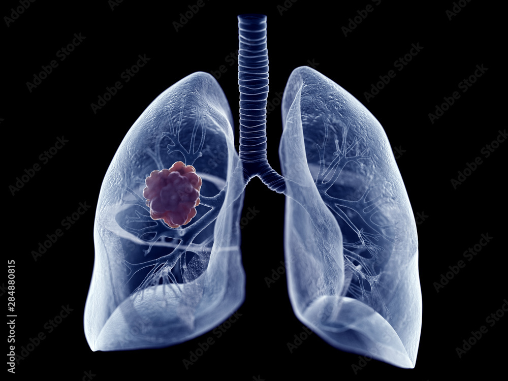 3d rendered medically accurate illustration of a lung tumor 3d rendered medically accurate illustration of a lung tumor