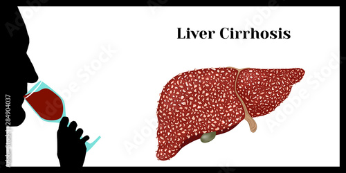 Cirrhosis. Violation of liver structure.