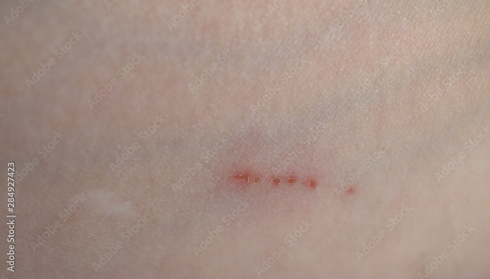 scratch scar on arm