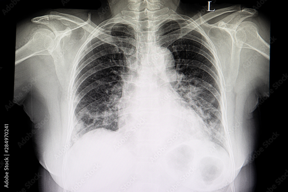 Φωτογραφία A chest xray film of patient with heart failure