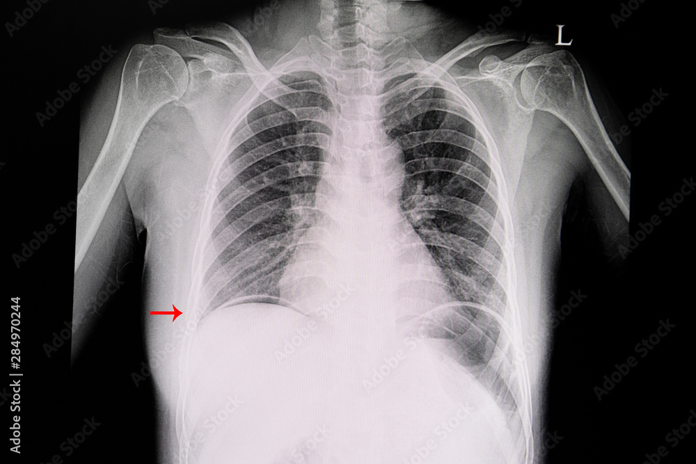 Φωτογραφία Chest xray of a patient showing free air in the abdominal cavity