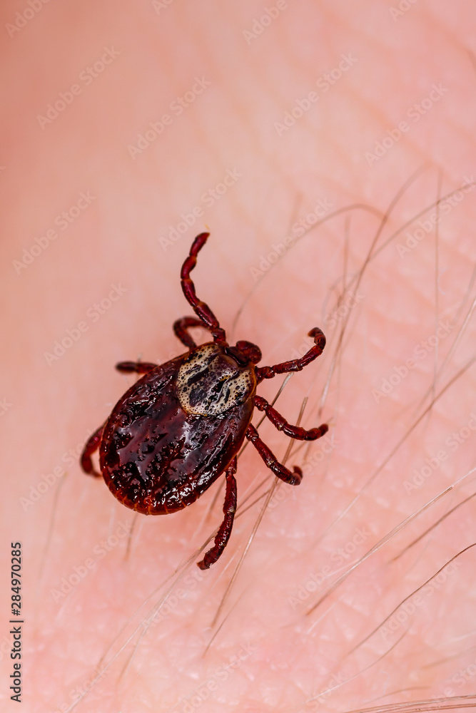 Encephalitis Virus or Lyme Borreliosis Disease Infectious Dermacentor Tick Arachnid Parasite Insect on Skin Macro Encephalitis Virus or Lyme Borreliosis Disease Infectious Dermacentor Tick Arachnid Parasite Insect on Skin Macro