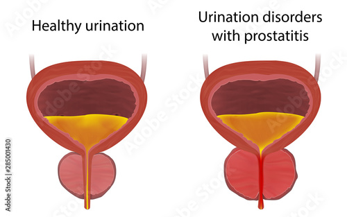 Urinary disorders with Prostatitis and healthy urination, comparison. Inflammation, infection. Realistic vector medical illustration.