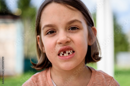 Fototapeta Portrait of toothless child girl missing milk and permanent teeth