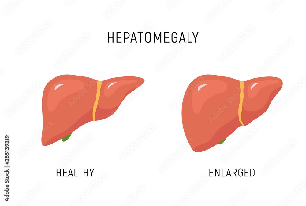 Enlarged liver hepatomegaly disease icon. Human liver health illustration anatomy design Stock
