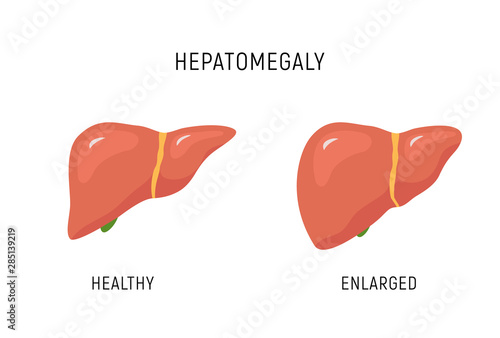 Enlarged liver hepatomegaly disease icon. Human liver health illustration anatomy design