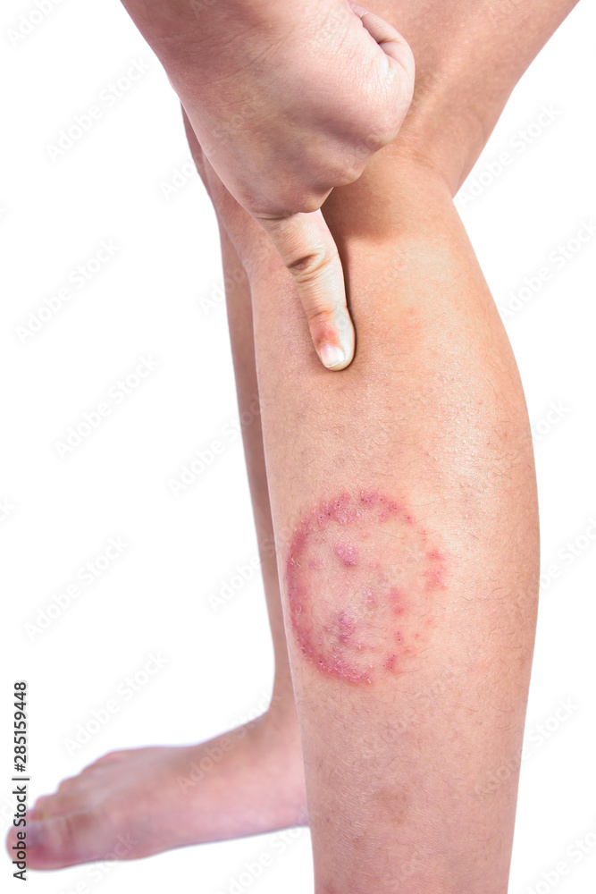 Foto de Ringworm infection or Tinea corporis on skin isolated on white  background, Dermatophytosis on skin isolated do Stock