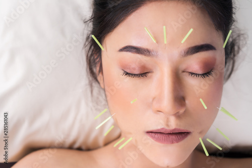 Tableau sur toile woman undergoing acupuncture treatment on face