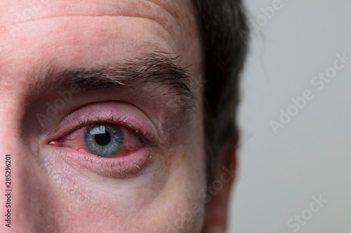 Close up of a severe bloodshot eye. Blepharitis, Conjunctivitis condition photo