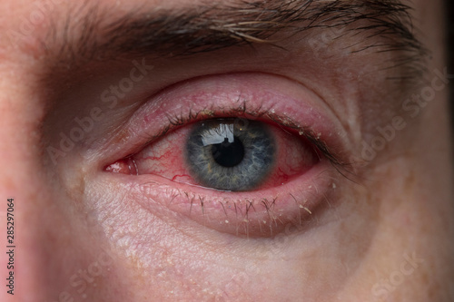 Close up of a severe bloodshot eye. Blepharitis, Conjunctivitis condition