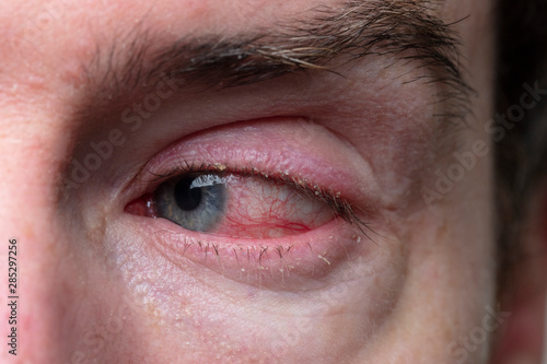 Close up of a severe bloodshot eye. Blepharitis, Conjunctivitis condition photo