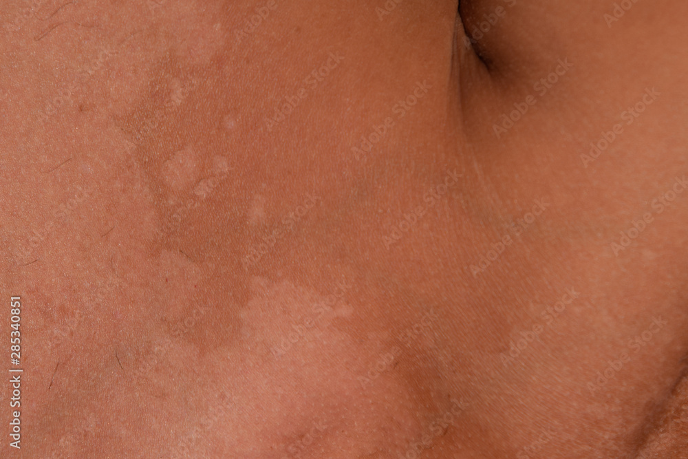 Fototapeta premium Sunburn on the skin of the shoulders. Exfoliation, skin peels off. Dangerous sun tan