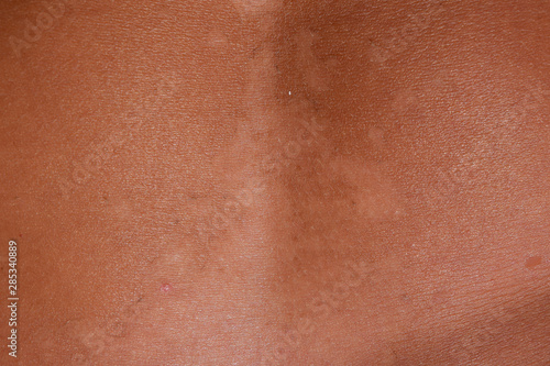 Sunburn on the skin of the stomach. Exfoliation, skin peels off. Dangerous sun tan