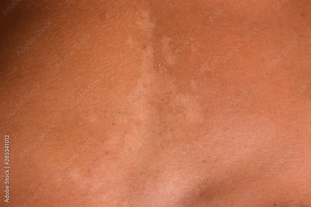 Sunburn on the skin of the stomach. Exfoliation, skin peels off. Dangerous sun tan Sunburn on the skin of the stomach. Exfoliation, skin peels off. Dangerous sun tan