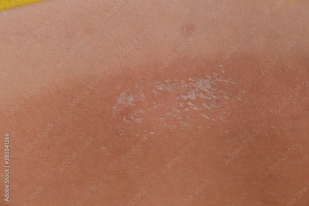 Sunburn on the skin of the back. Exfoliation, skin peels off. Dangerous sun tan Sunburn on the skin of the back. Exfoliation, skin peels off. Dangerous sun tan