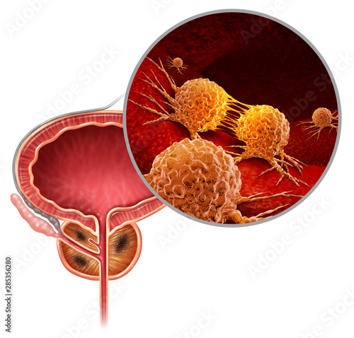 Cancer Of The Prostate photo